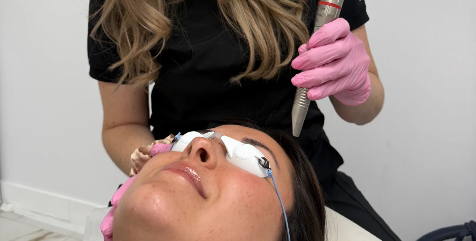 Traitement au laser Fotona Dynamis SP sur le visage d’une patiente portant des lunettes de protection