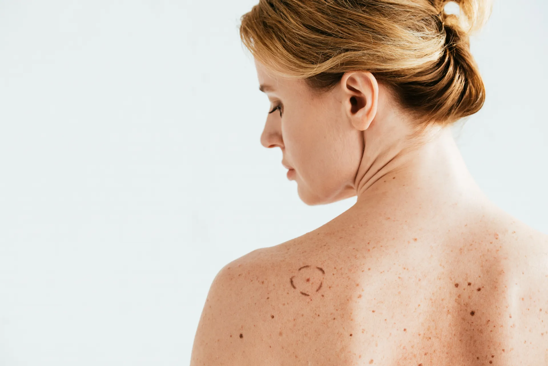 Femme de dos, l’épaule parsemée de grains de beauté dont l’un est encerclé au crayon pour examen