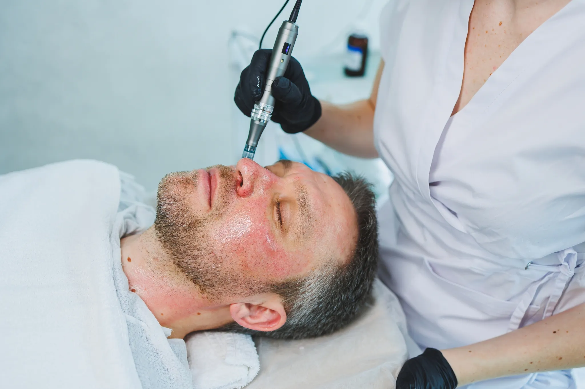 Application d'un traitement de micro-aiguilletage sur le visage d'un patient