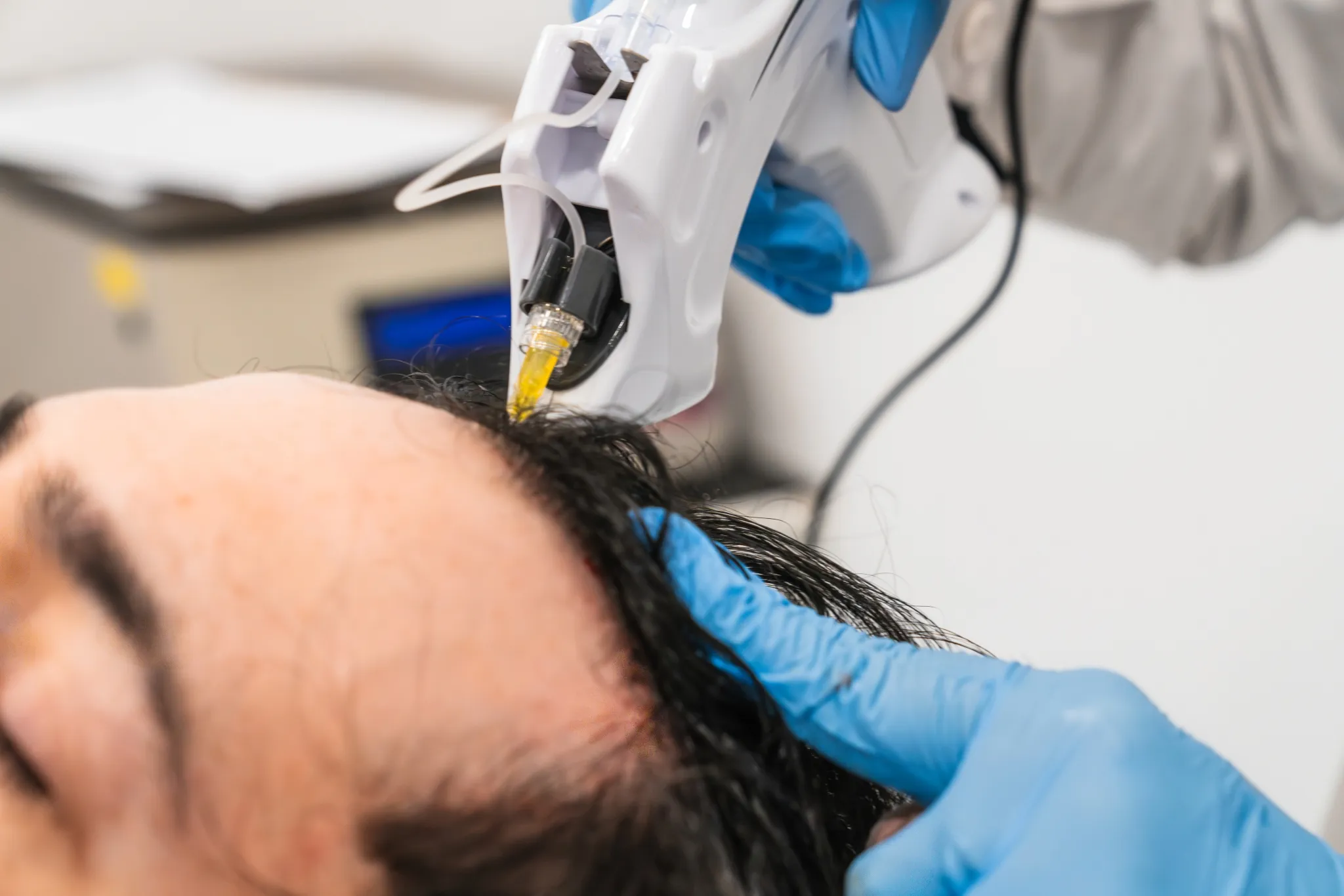 Traitement injecteur pour la restauration capillaire en clinique
