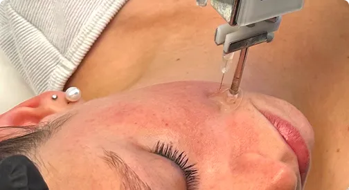 Injection capillaire thérapeutique pour la densité des cheveux